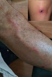Image result for Nodular Lymphangitis