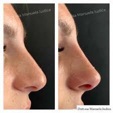 Sei alla ricerca delle migliori app per modificare il naso? Filler Naso Dottoressa Iudica Catania Siracusa Lentini