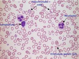 The following features in a blood smear help us identify an imha (reviewed by. 26 Introduction To Haematology And Transfusion Science Basicmedical Key