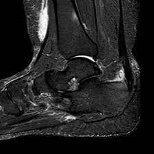 Haglund's syndrome is a group of signs and symptoms consisting of haglund's deformity (which is an exostosis of the posterior calcaneal tuberosity) in combination with retrocalcaneal bursitis. Haglund Syndrome Radiology Reference Article Radiopaedia Org