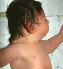 Cette malformation est également appelée syndrome de down. Down Syndrom Trisomie 21 Gesundheitsprobleme Von Kindern Msd Manual Ausgabe Fur Patienten