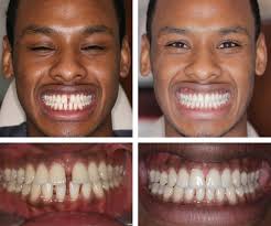 Cosmetic Dentures in Harley St, Central London W1, UK