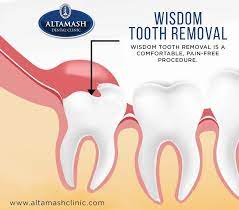 Pin On Wisdom Tooth Removal