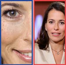 Anne Will Schönheits Op