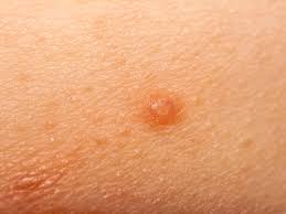 It affects people of all races, genders and ages, which is why it's absolutely critical for americans to learn about. Skin Bumps That Look Like Pimples But Aren T