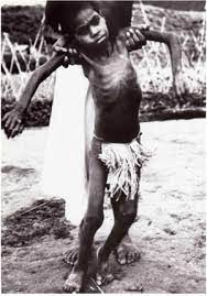 When cannibalism stopped, kuru disappeared within a generation. Kuru Disease Wikipedia