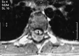 Image result for Spinal Epidural Abscess