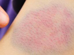 What helps bruises fade quickly? How To Get Rid Of Bruises 7 Effective Home Remedies