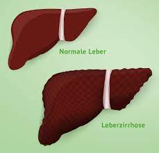 Leberzirrhose
