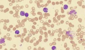For any pet owner, it's the worst of all possible news. Lymphoma In Dogs Petcoach