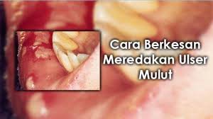 Ianya boleh berlaku pada bahagian ulser di mulut ini kebiasaannya muncul kerana badan kekurangan vitamin b12, vitamin. Tips Berkesan Menangani Ulser Mulut Adakah Anda Tahu Facebook