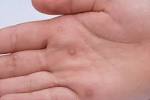 Cyst On Balls