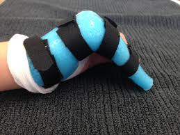 A 50 mm long and 30 mm wide digital proximal splint, designed to immobilize the proximal articulation of the finger (the one. Paediatric Hand Fractures Bondi Junction Hand Therapy
