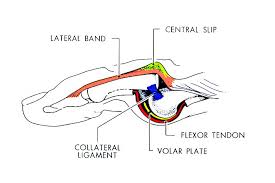 Image result for Lateral PIP Dislocation