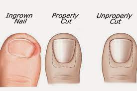 Properly trimmed toenails will help you to avoid developing ingrown toenails which can be painful and can lead to infection. How Do You Get An Ingrown Toenail