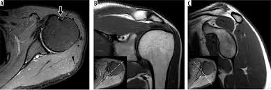 Image result for Shoulder Imaging