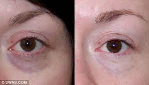 While vitamin k deficiencies are rare in adults, they are very common in newborn infants. Winter Ages A Woman S Eyes By Nearly Five Years As Vitamin D And Happy Hormone Levels Drop Daily Mail Online