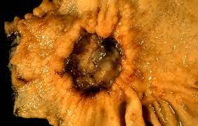 Cancer De L Estomac Wikipedia