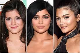 Kylie Jenner Before and After Plastic Surgery