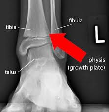 Image result for Growth Plate