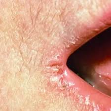 Physicians have not been able to find the specific source for fractured edges of mouth. What Causes Cold Sores In The Corner Of My Mouth Quora