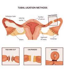 Tubal Ligation Benefits Risks And Alternatives