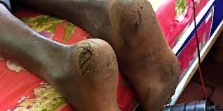 Doch nicht nur aus ästhetischen gründen sollten sie beim schneiden und feilen der nägel sowie hobeln der hornhaut behutsam. Studie Hornhaut An Den Fussen Je Mehr Desto Gesunder