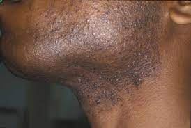 I would like some advice on how to stop this. Razor Bumps Causes Prevention Learn How To Get Rid Of Razor Bumps