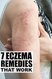 7 Eczema Remedies That Work Eczema Remedies Eczema Treatment Home Remedies For Warts