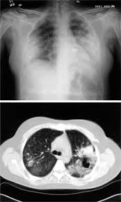 Reload to refresh your session. Use Of Extracorporeal Membrane Oxygenation In A Patient With Diffuse Alveolar Hemorrhage Chest