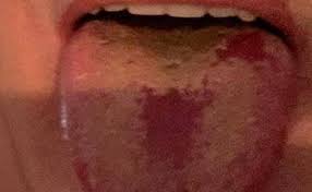 Alguns pacientes podem apresentar dores, congestão nasal, dor de cabeça, conjuntivite, dor de garganta. Sintomas De La Covid 19 Un Experto Britanico Alerta De La Existencia De Un Nuevo Sintoma Del Coronavirus Ideal