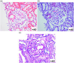 The abnormal human condition now called amyloidosis has been known for a long time, initially under various names, such as lardaceous or waxy change. Kidney Pathology A Congo Red Stain Showed Characteristic Amyloid Download Scientific Diagram