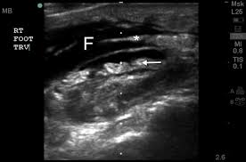 The affected area starts to swell and may show a purplish rash and redness in. Point Of Care Ultrasound Diagnosis Of Necrotizing Fasciitis Missed By Computed Tomography And Magnetic Resonance Imaging Journal Of Emergency Medicine