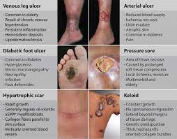 Wound Care - How To Clean And Treat Open Wound Or Infected Wound