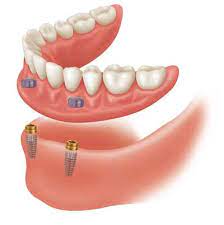 What Are Denture Implants Permanent Dentures Cost Overdentures Snap In Boise Meridian Idaho