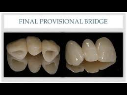 747,000 virginians under age 65 do not have health insurance. Dental Bridge The Esthetic Provisional Bridge Dental Bridge Dental Office Gift Dental Help