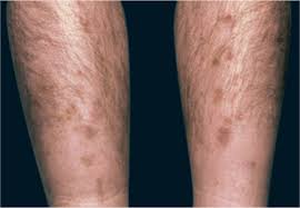 Having had blue spots of my own, which are now large. Skin Manifestations Of Diabetes Mellitus Endotext Ncbi Bookshelf