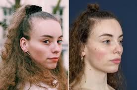 The pages within this menu have been carefully chosen to provide you with everything that you might be looking for related to men's hair loss. Transgender Hair Transplant 2pass Clinic