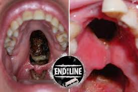 A bump on the roof of mouth can mean oral cancer, ulcers, some stds, allergies, canker sores etc. The Horrific Effects Of Cocaine Eroding The Roof Of Your Mouth Leaving Gaping Holes