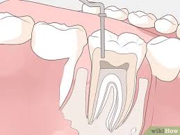 Oral antibiotics can kill the bacteria causing the infection and keep the infection from spreading. How To Get Rid Of A Gum Boil 10 Steps With Pictures Wikihow