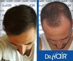 Drhair Hair Transplantation Sac Ekimi Sac