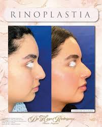 Rinoseptumplastia 1 semana de posoperada! Mejoramos dorso y punta para una  mejor definición y lograr un cambio radical en el rostro! La  Rinoseptumplastia es el procedimiento quirúrgico ideal Para quien desea  mejorar
