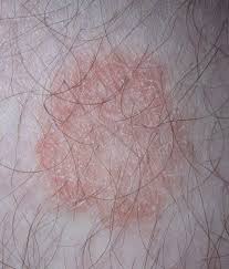 Ringworm, or tinea, is a skin problem caused by fungus. Dermatophytosis Wikipedia