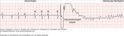 Image result for Synchronized Cardioversion