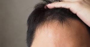 Asian hair is naturally thick and strong, and usually tolerates being bleached very well. Androgenetic Alopecia In Asian People Rhrli