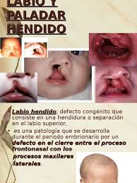 Cuidar a un hijo con el paladar hendido puede requerir mucho tiempo y paciencia. Labio Leporino Y Paladar Hendido Especialidades Medicas Bienestar