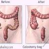 At first we mobilized the splenic flexure to have loose tension of the anastomosis. Https Encrypted Tbn0 Gstatic Com Images Q Tbn And9gctk Bsw9tgazy6lu1yaroqmnvhqyk7ujnr0ov3qhgvb4kdn Lp5 Usqp Cau