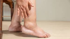 StrideOn - Being diagnosed with a blood clot in the lower leg, also known  as deep vein thrombosis (DVT), can feel like life has suddenly hit pause.  Whether caused by injury, surgery,