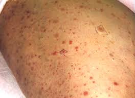 Platelets are cell fragments that help blood clot more effectively, preventing dangerous bleeding. Petechial Rash On The Extremities The Bmj