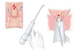 Acest medicament pentru tratamentul hemoroizilor are un efect analgezic și terapeutic bun. Tratament Rapid Hemoroizi Interni